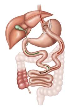 Gastric Bypass illustration
